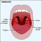 Tonsillitis